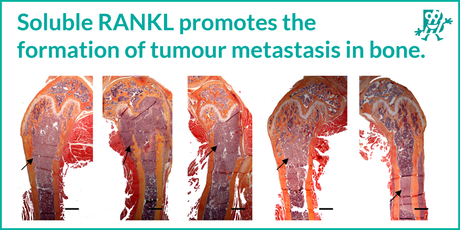 Soluble RANKL promotes the formation of tumour metastasis in bone